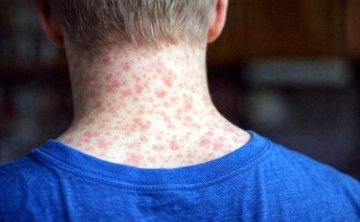 Reportan incremento de muertes por sarampión en México